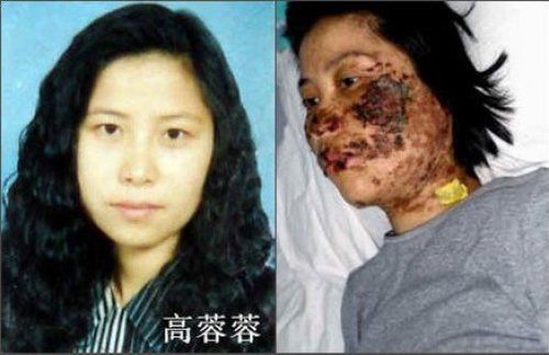 法轮功学员高蓉蓉被中共警察电击前后对比照片。