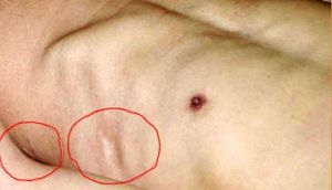 '照片：邵承洛被捣刮肋骨后遗留下的伤疤'