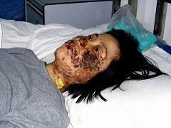 '高蓉蓉2004年5月7日被酷刑折磨，脸上是电烧灼伤。照片是受伤10天后拍摄的。'