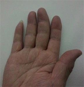 图3：王晓玲右手手指变形。